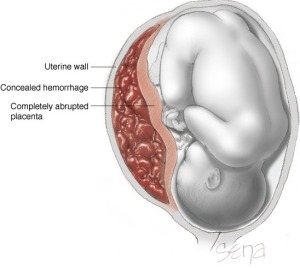 Solusio placenta