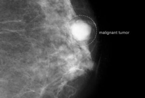 Mammografi malignant_tumor